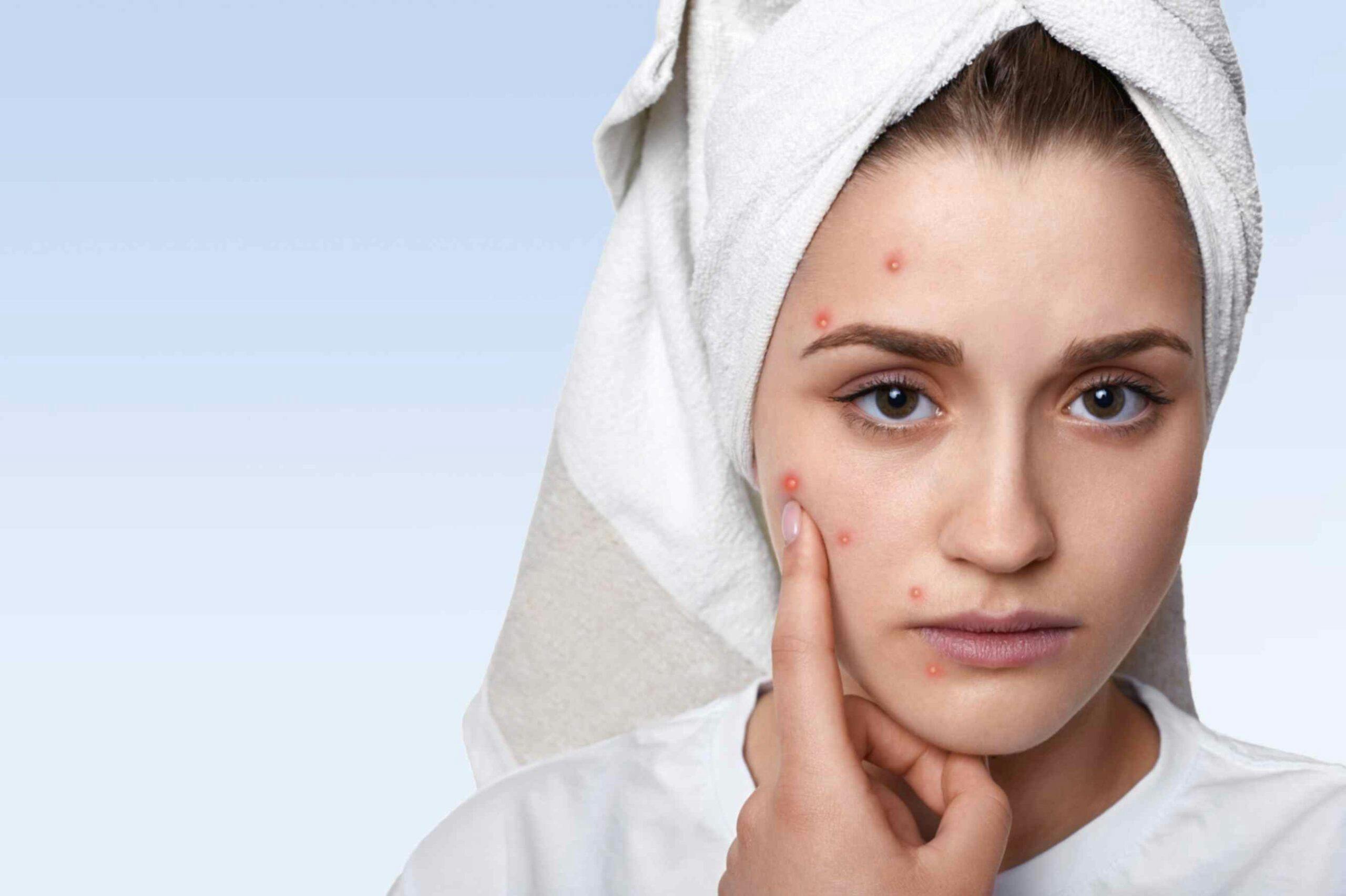 Acne Breakout: Causes & Solutions